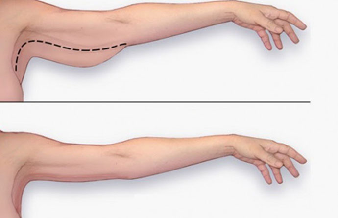Tiêm giảm bắp tay với công nghệ FUSION MESO (TIÊM) Tại TPHCM
