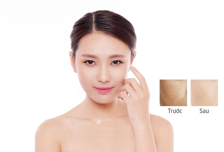 Meso Fill Korea – cấy nano sợi collagen căng da, trắng da tại TPHCM
