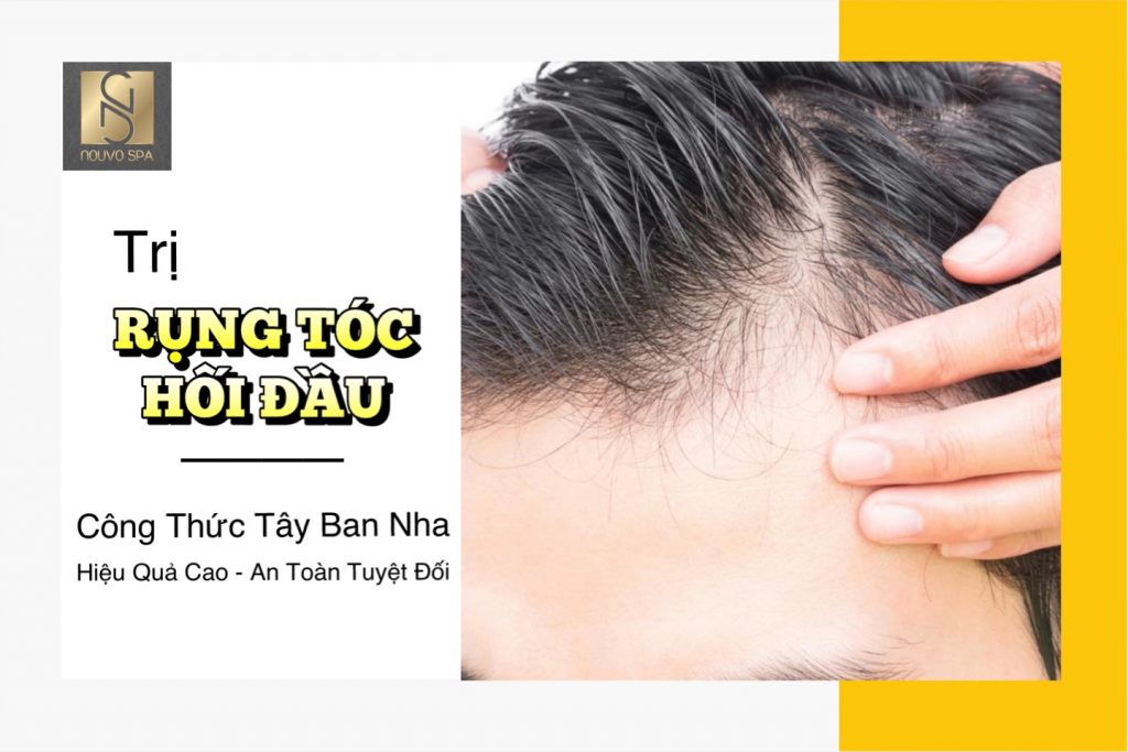 Điều trị rụng tóc - Hói đầu bằng công thức Tây Ban Nha
