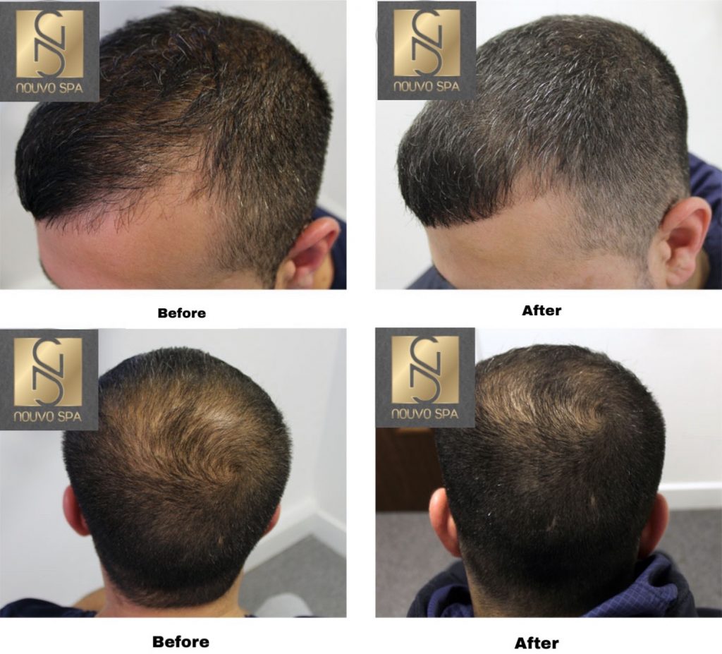 Trước và sau khi tiêm trị rụng tóc