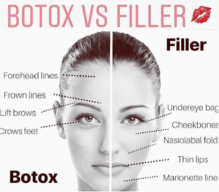 So sánh giữa Botox với Filler