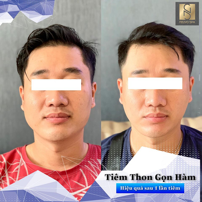 Hình ảnh khách hàng trước và sau khi tiêm Botox thon gọn hàm
