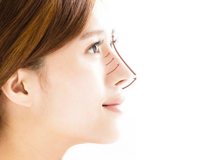 Nâng mũi bằng chỉ – 6 thông tin bạn không nên bỏ qua